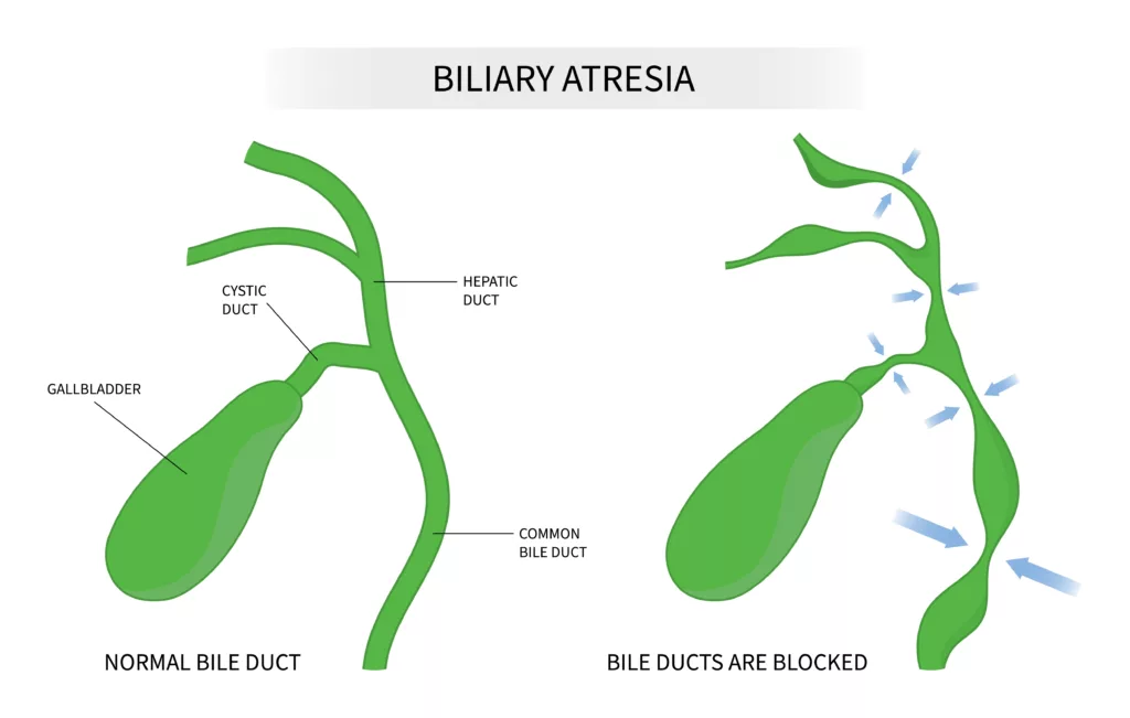 Billary atresia and bile duct