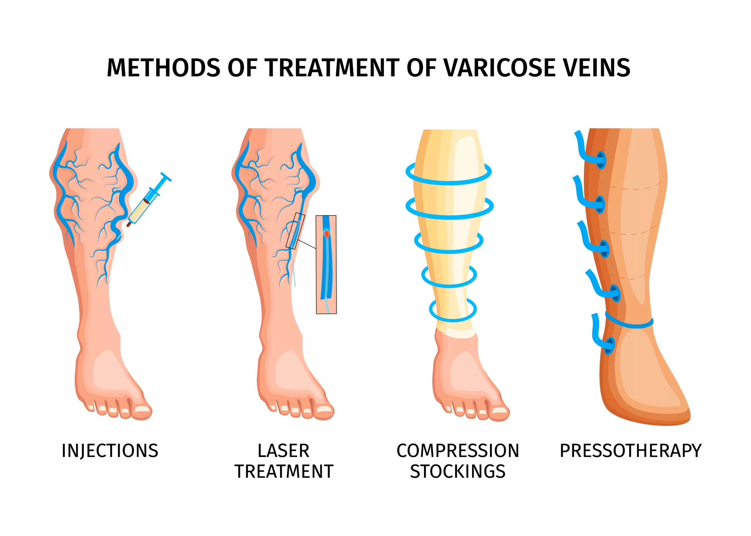 Microphlebectomy and other treatment options for varicose veins