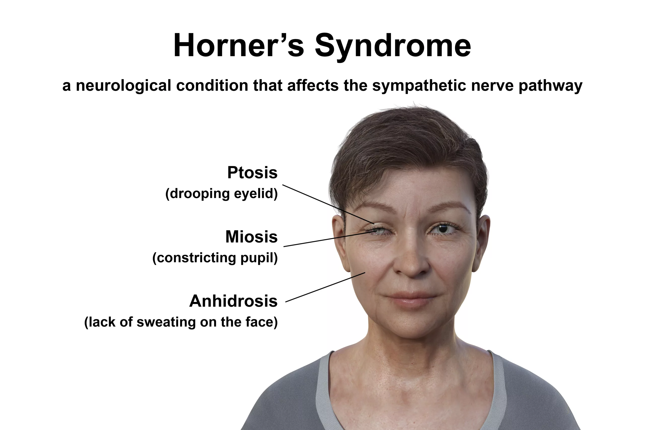 Horner syndrome