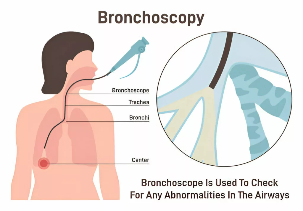 Bronchoscopy for diagnosing Atelectasis