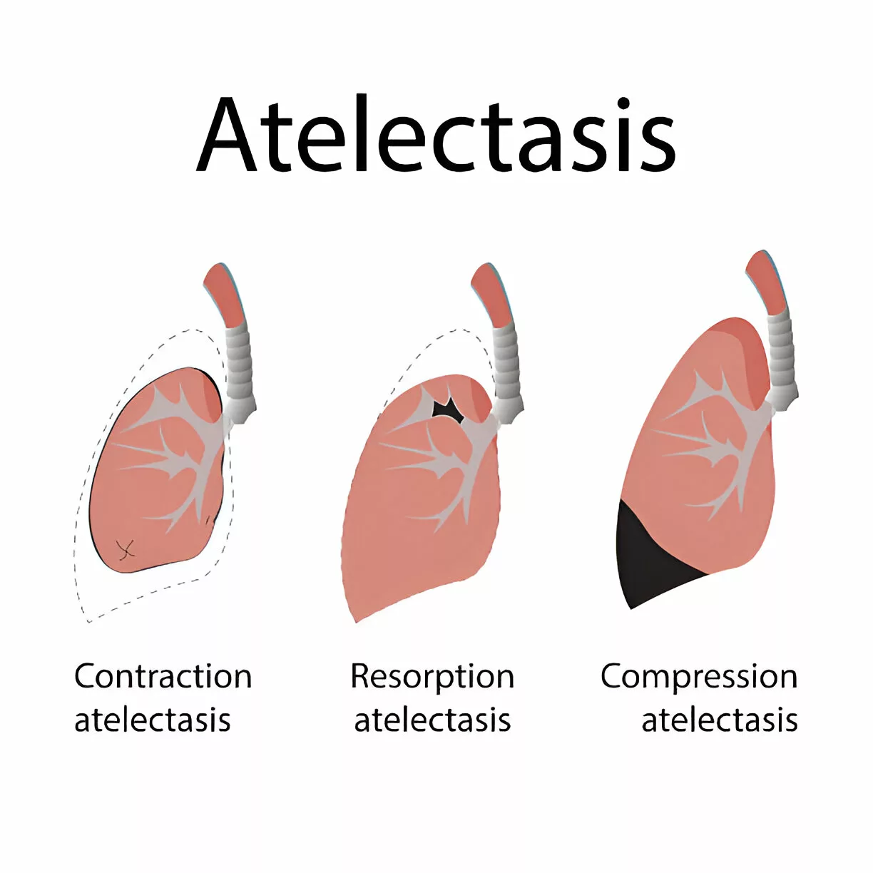 types of atelectasis