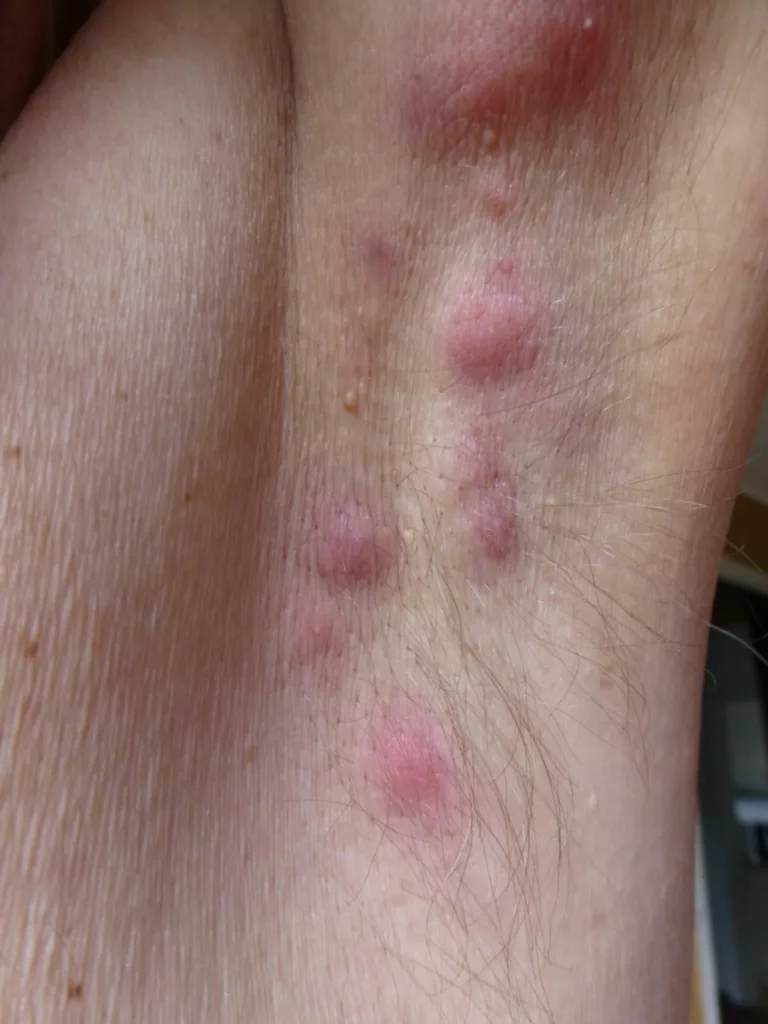 Acne inversa, hidradenitis suppurativa in the armpit (inflammatory skin disease)