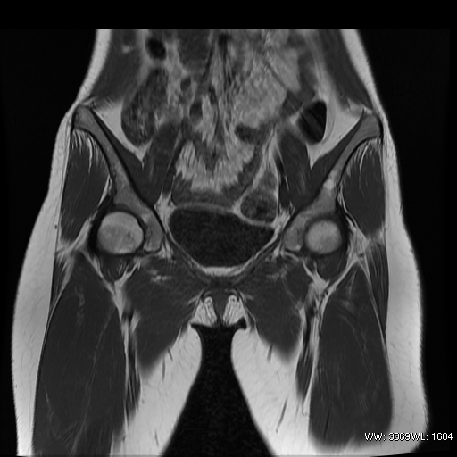 MRI showing groin pull