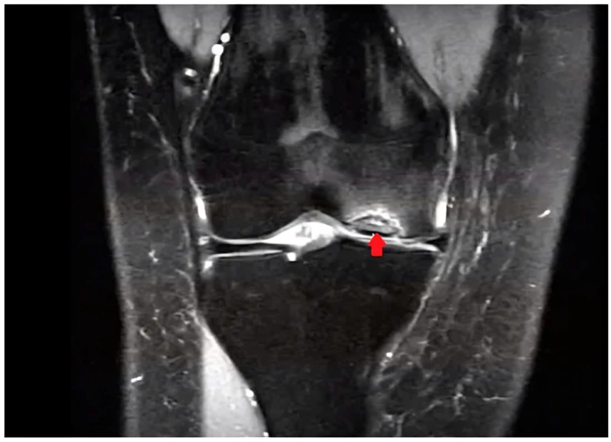 OCD of the medial femoral condyle as seen on an MRI (coronal view, T2-weighted). The arrow indicates OCD of the medial condyle of the femur. Image courtesy:Relationships between Iron Status and Selected Physical Fitness Components of South African Adolescents: The PAHL-Study" by authors from the Children journal, published by MDPI, licensed under CC BY 4.0