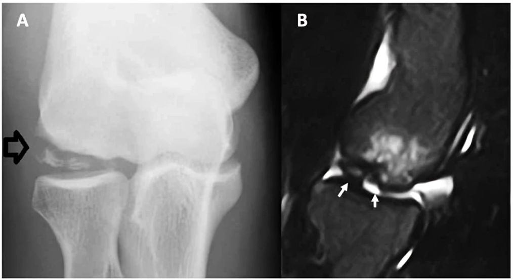 Radiographic (A) and computed tomography (B) pictures of humeral OCD. Arrows indicate OCD in the humeral head. Image courtesy:Relationships between Iron Status and Selected Physical Fitness Components of South African Adolescents: The PAHL-Study" by authors from the Children journal, published by MDPI, licensed under CC BY 4.0