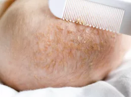 Image showing baby having cradle cap condition