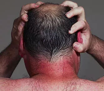 Rash at the back of the head.