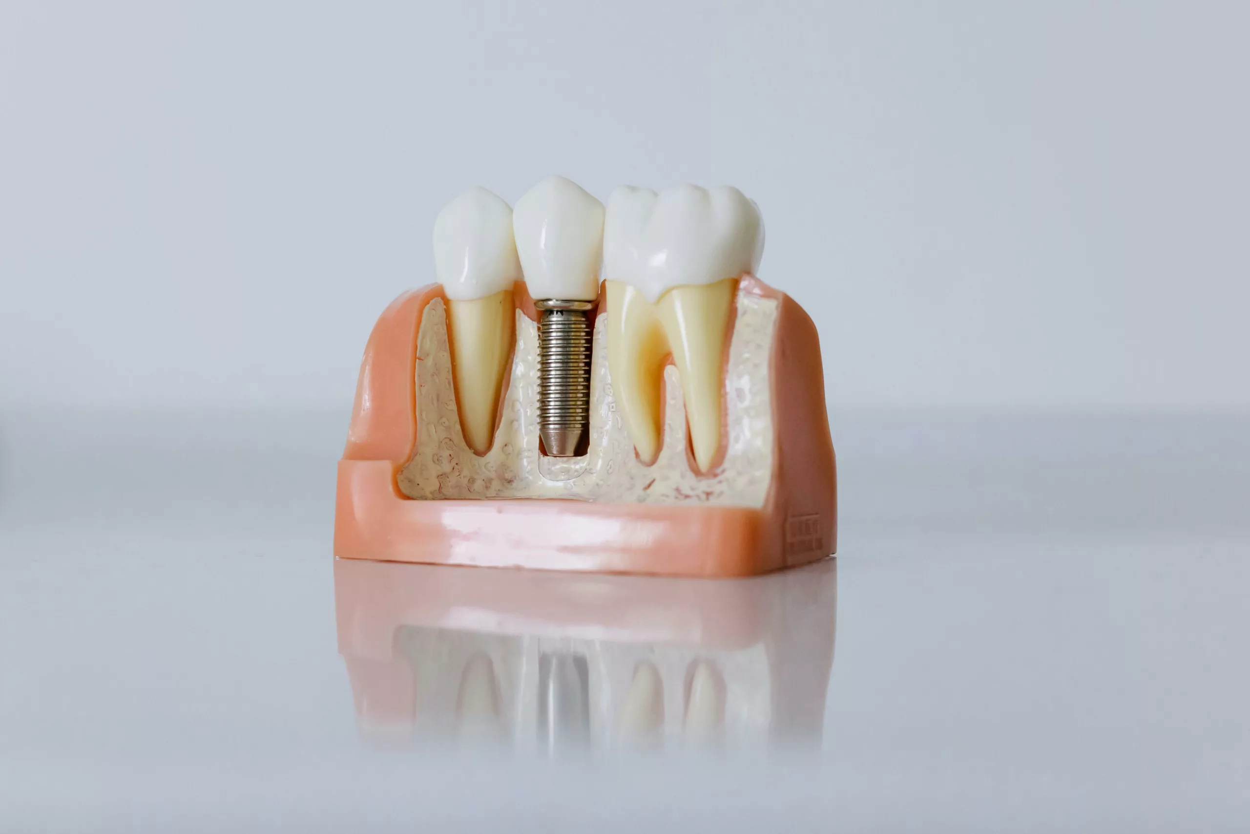 Dental implant, an alternative to dental flipper