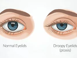 Difference Between Normal Eye and Ptosis