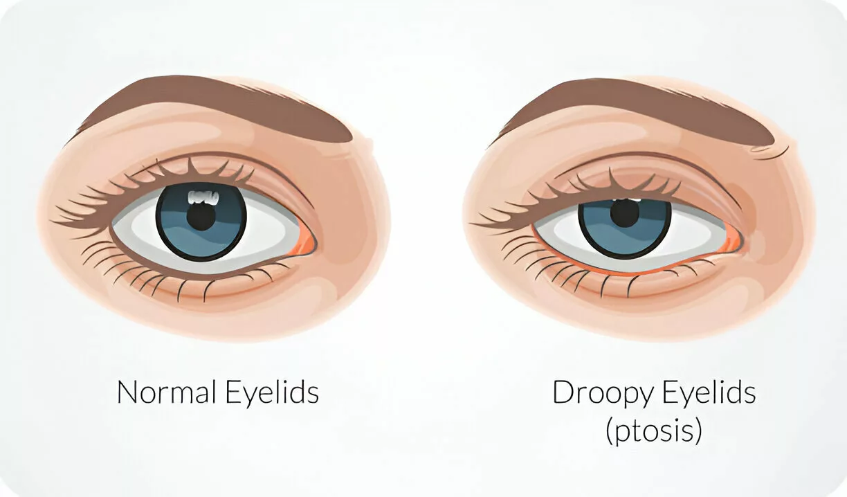 Difference Between Normal Eye and Ptosis