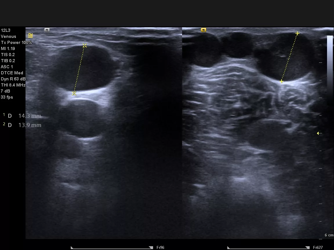 Varicose veins need microphlebectomy