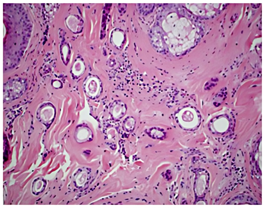 Characteristic syringoma with double-layered duct-like structures