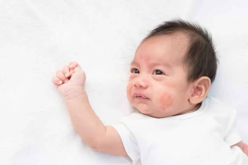 Image showing eczema rashes on baby's face