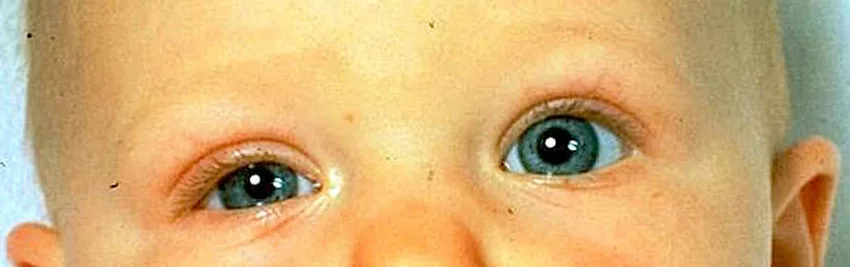 The infant with right Horner syndrome