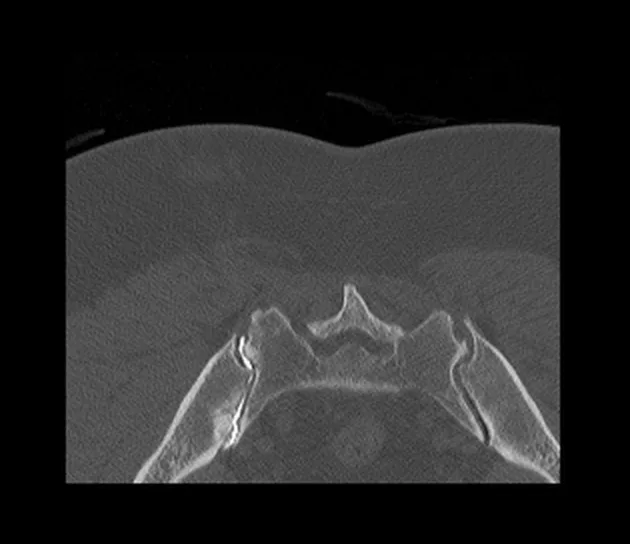 CT Arthrogram of Sacroiliac Joint