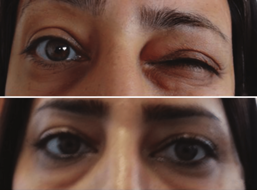 Patient's face: (a) before Dysport injection, showing severe blepharospasm. (b) After Dysport injection showing improvement in blepharospasm. 