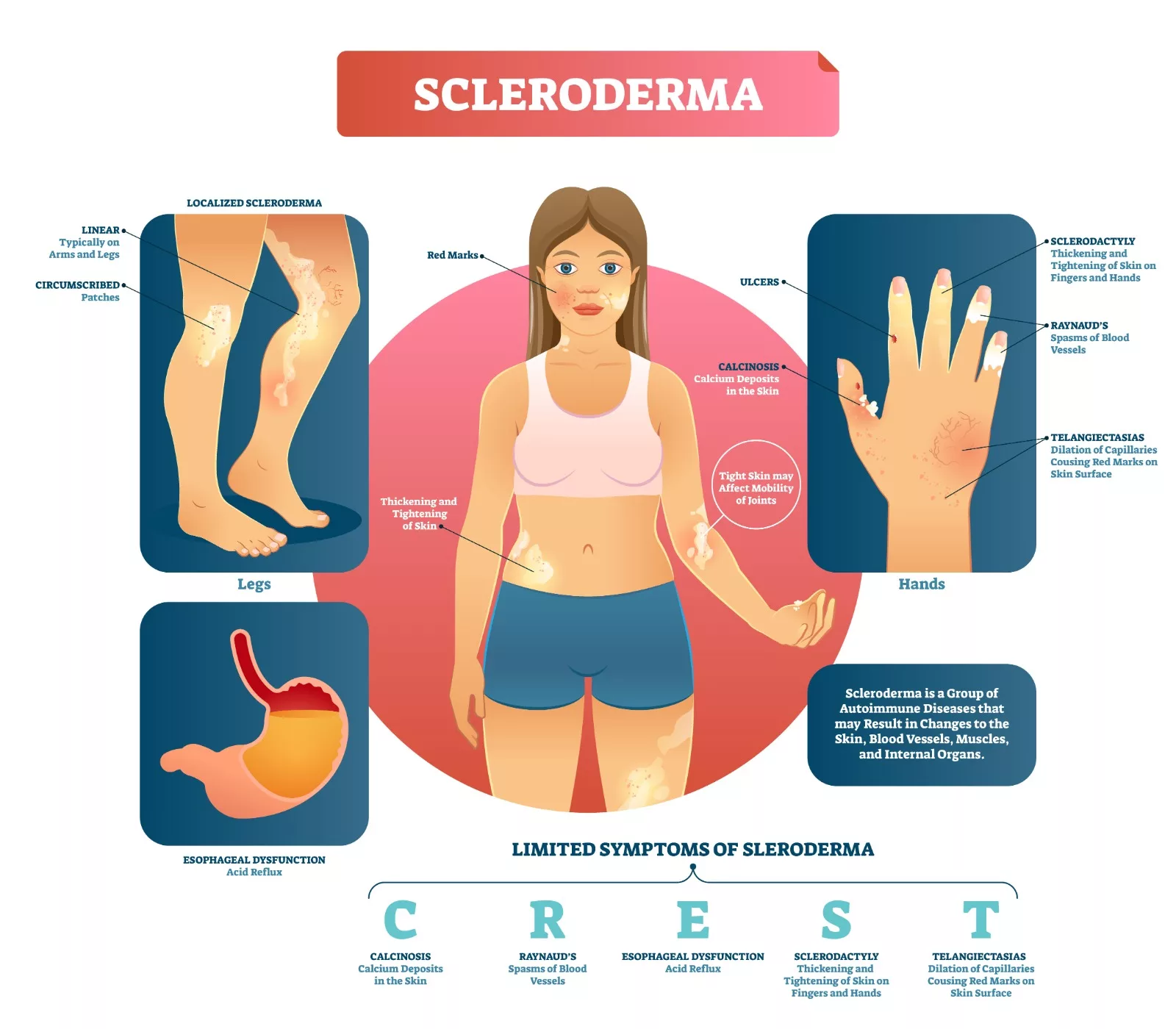 Limited symptoms of scleroderma.