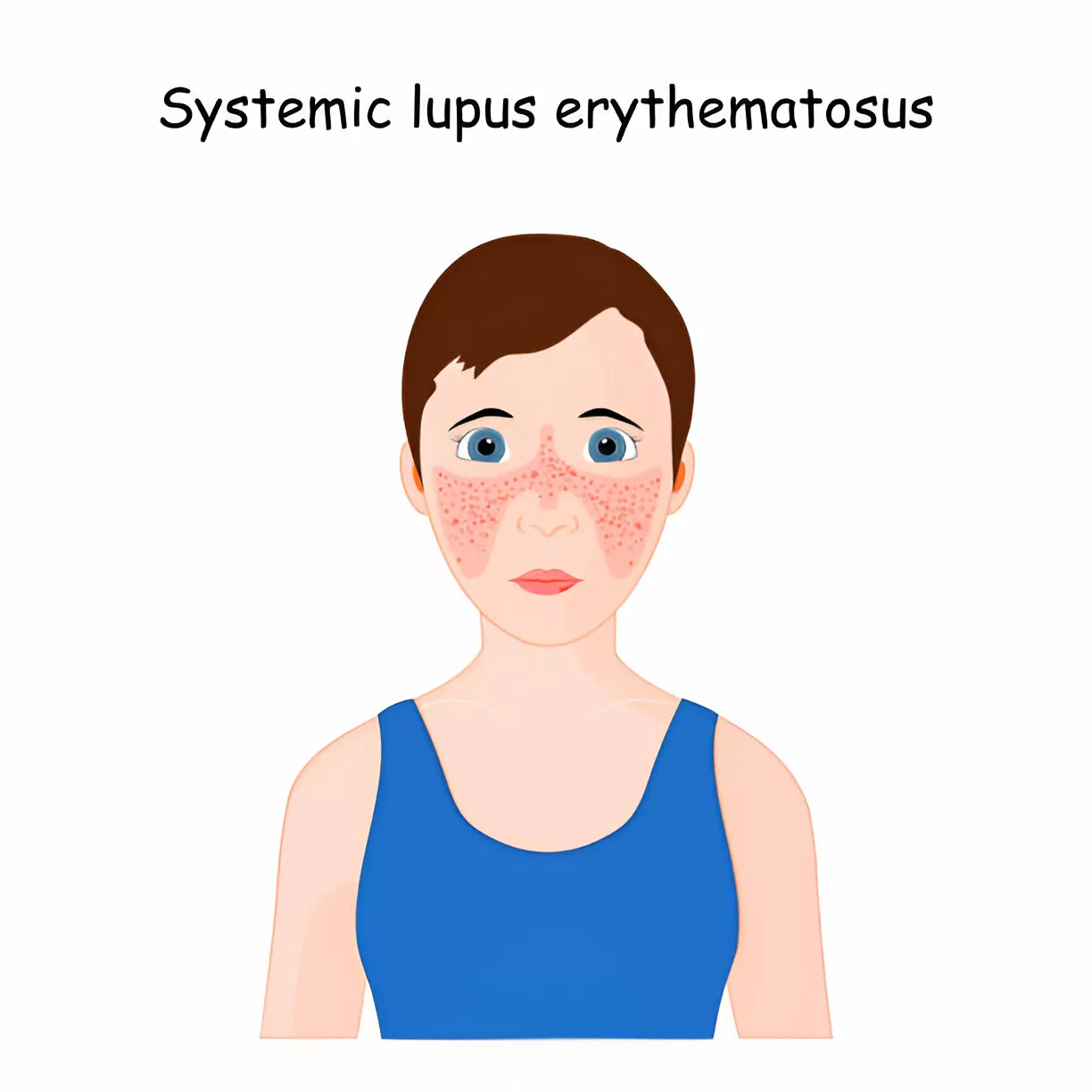 Malar Rash in SLE patient