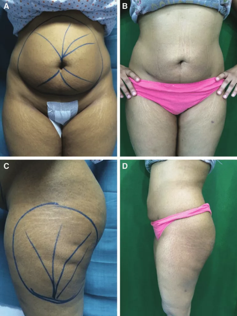 Image shows the results after 6 months of Laser Liposuction