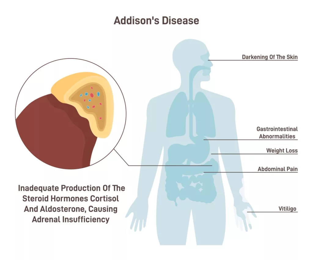 Addisonian Crisis