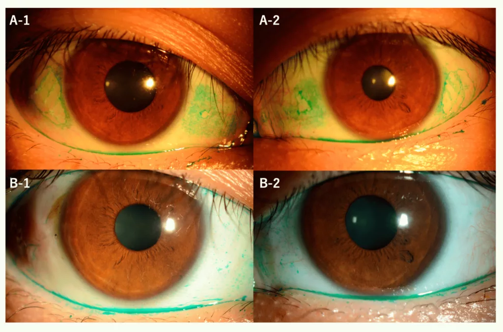 Image shows Bitot's spots before and after surgery