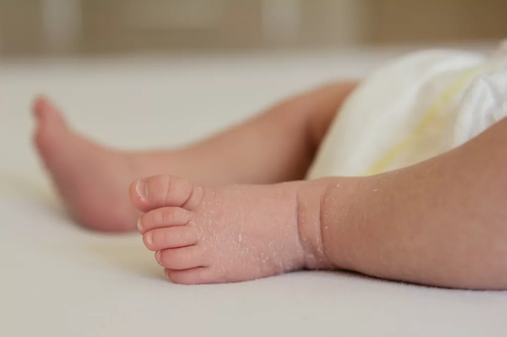 Image showing dry skin around baby's leg