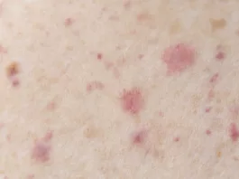 Lichen planus