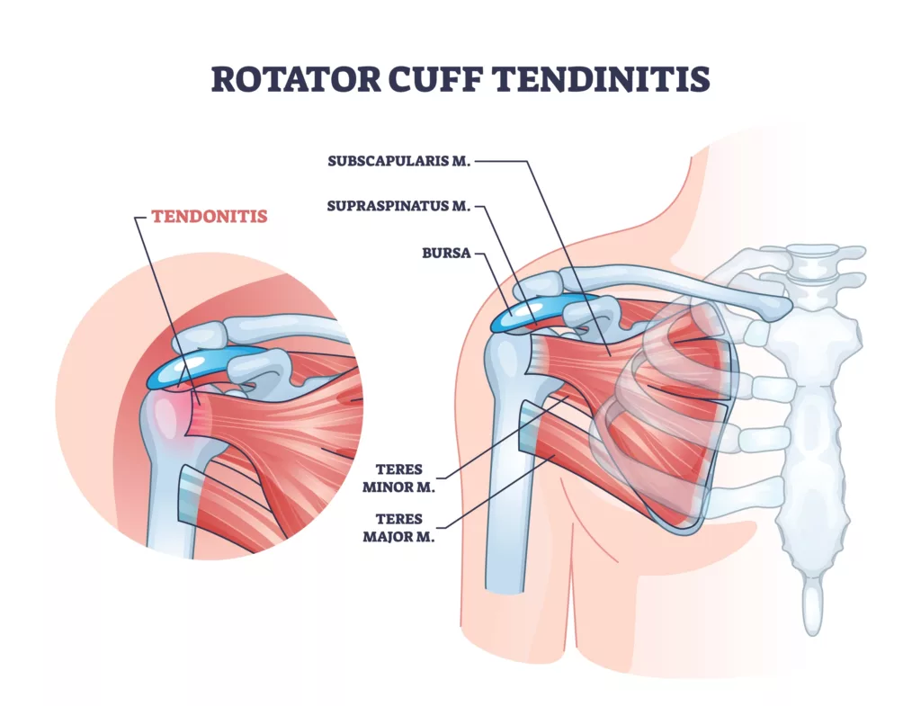 Illustration of Rotator Cuff Tendintis