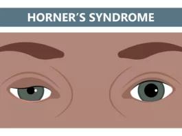 Horner’s syndrome