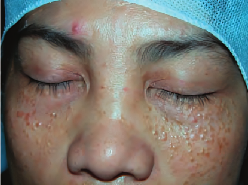 A 38-year-old woman with periorbital syringomas