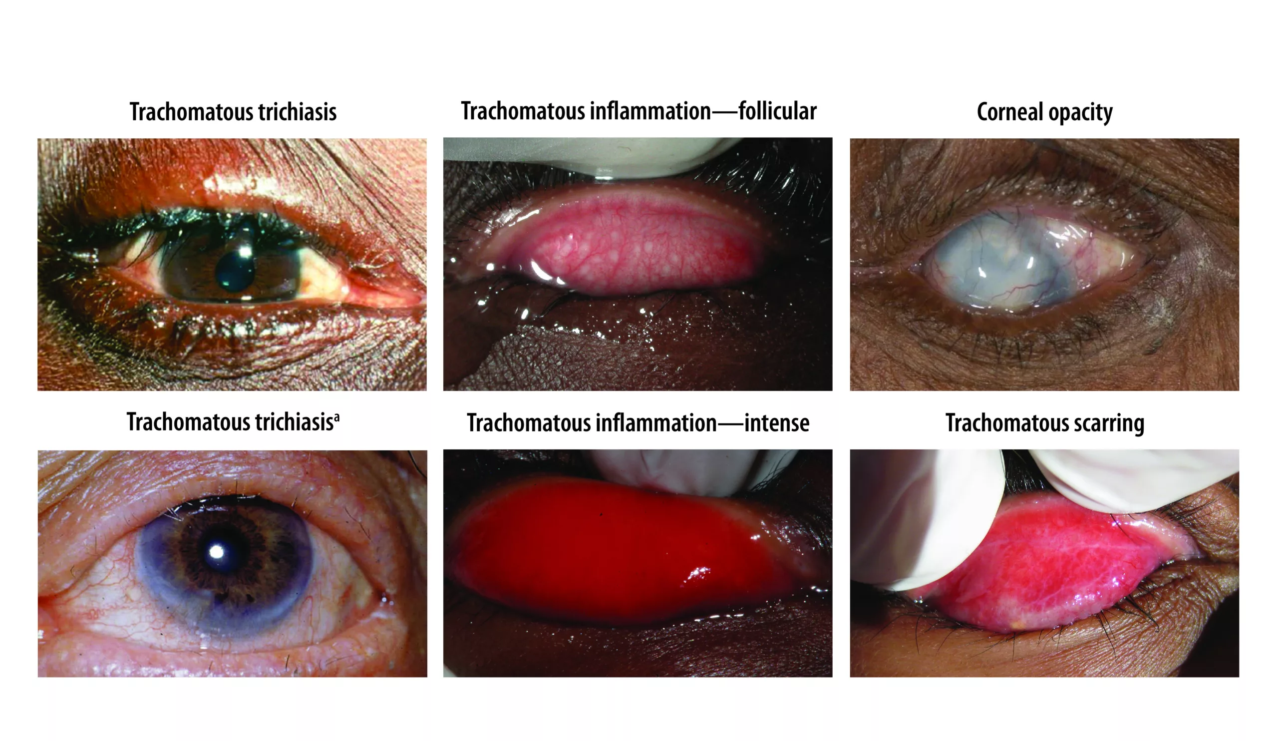 Trachoma stages