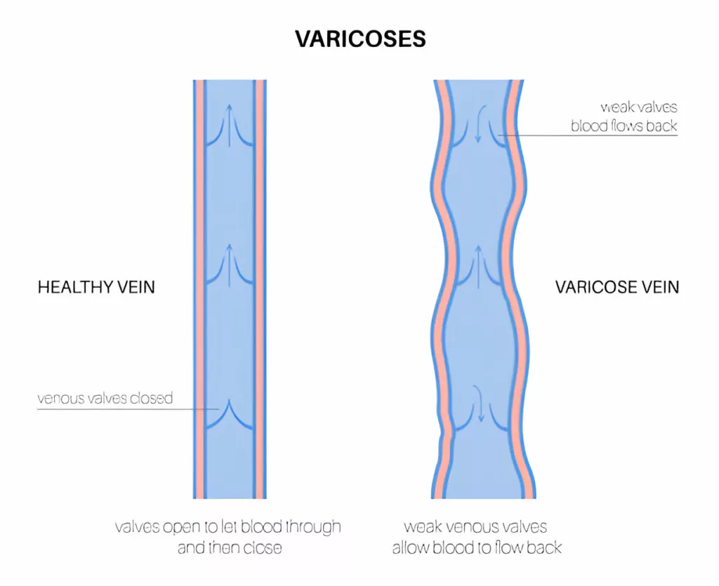 Healthy vein Vs Varicose Vein