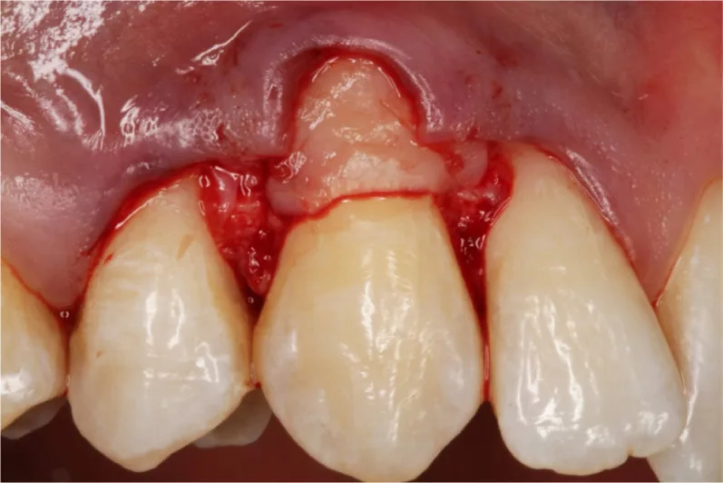 Gum graft