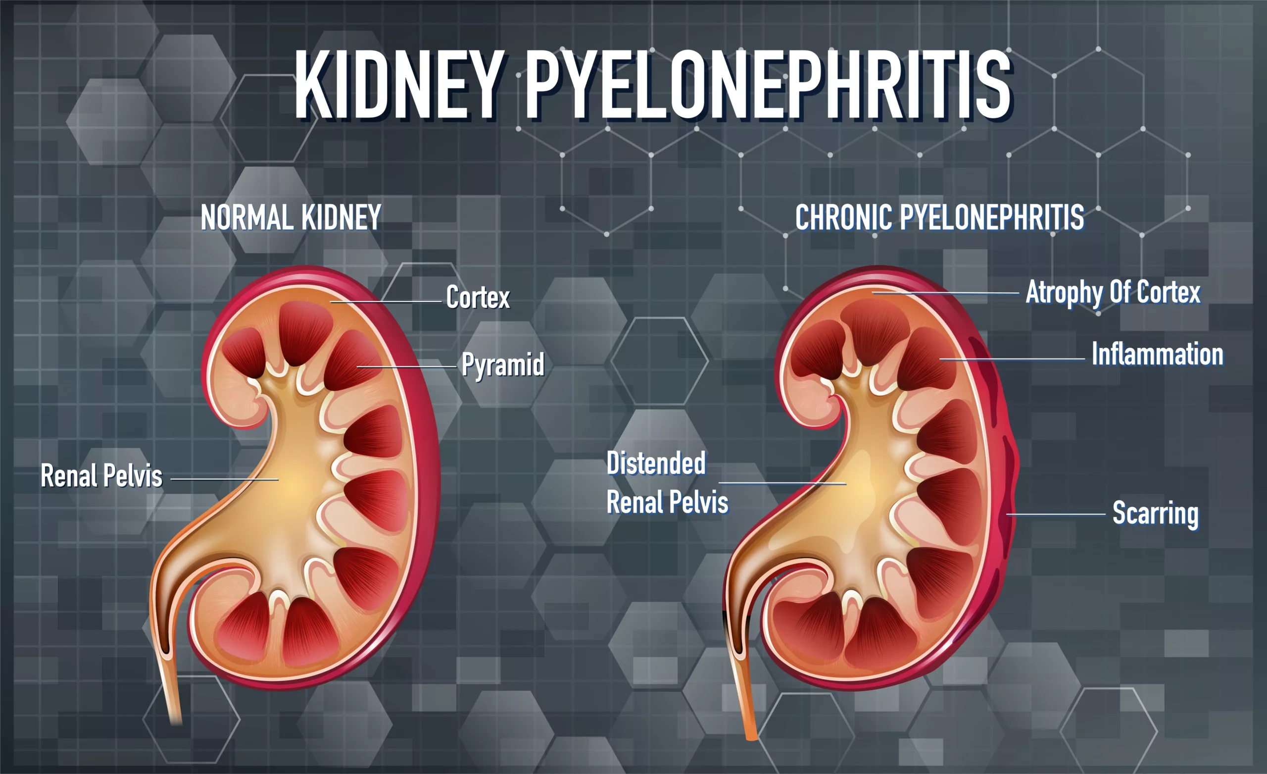 Visual Difference between a Normal Kidney and Chronic Pyelonephritis