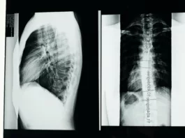 Lumbar scoliosis X-ray