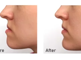 Before and After Orthognathic Surgery