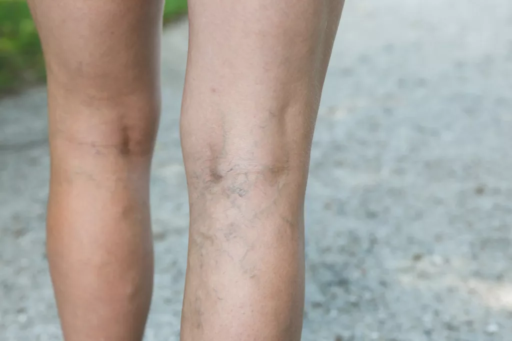 The image shows Reticular veins on the legs