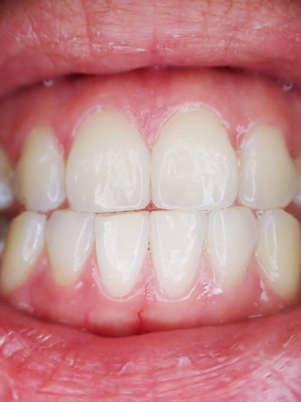 Healthy gingiva after gum grafting