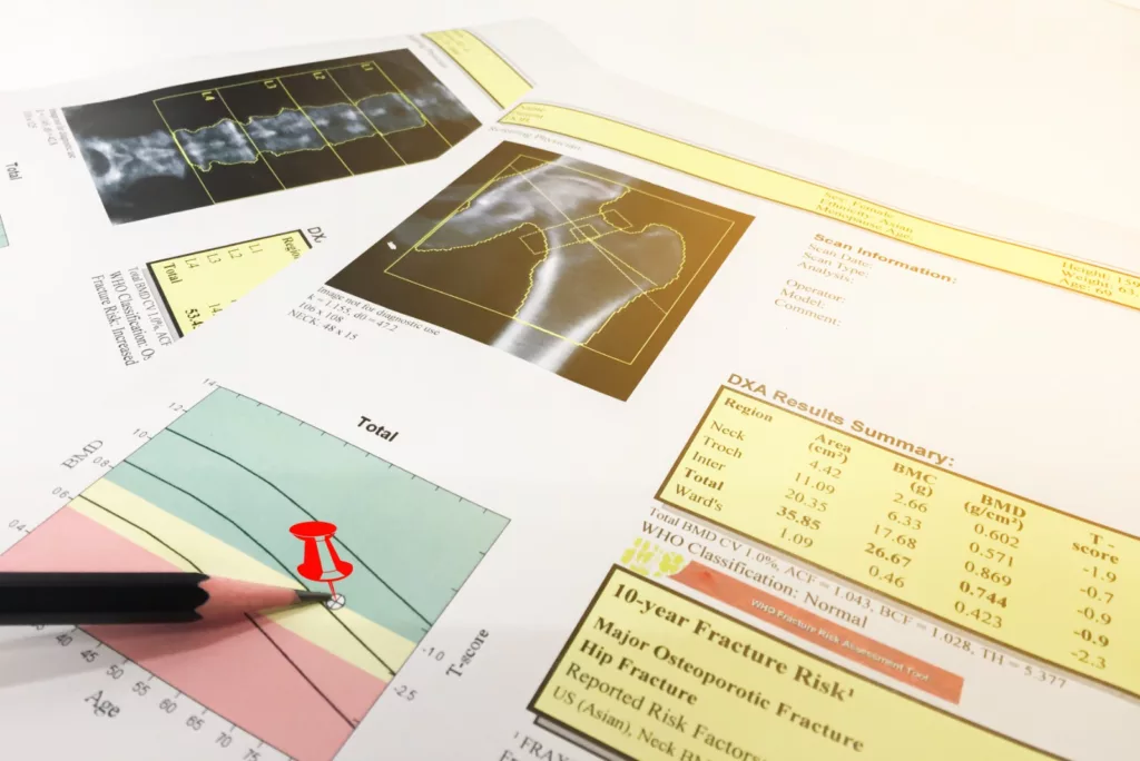 DEXA densitometry hip scan