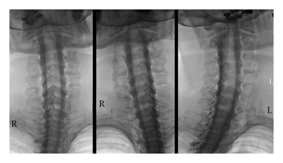 Cervical myelography (prone position). 