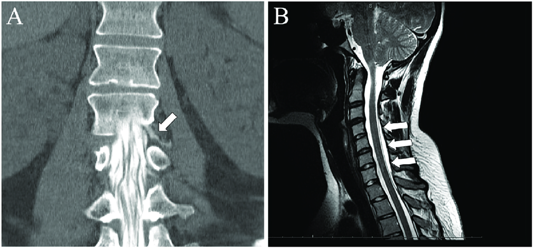 Coronal images from a CT myelogram