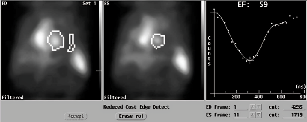 MUltiple Gated Acquisition (MUGA) scan showing left ventricular ejection fraction (LVEF), end-diastolic (ED) diameter and end-systolic (ES) diameter at baseline. 