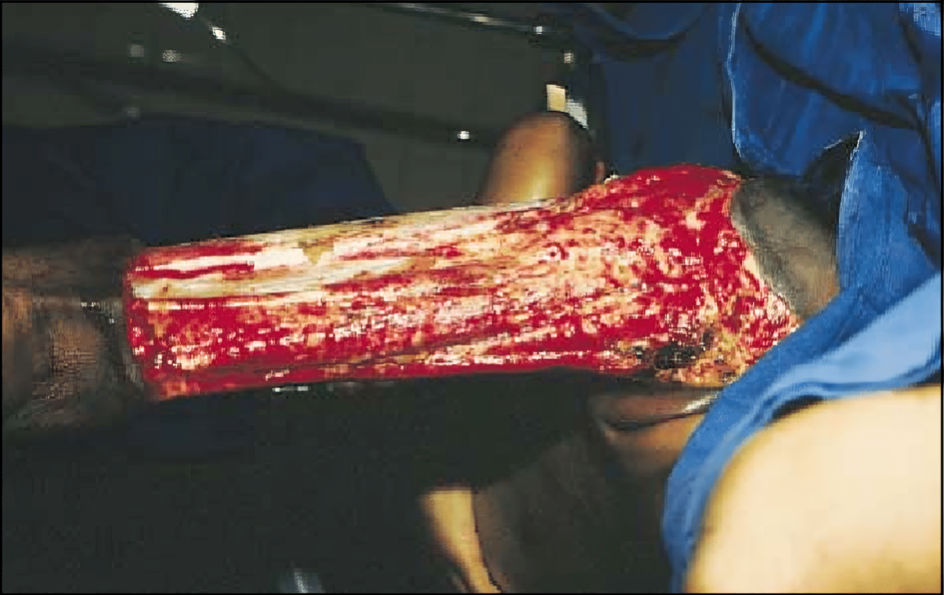 Necrotizing fasciitis after extensive surgical debridement of necrotic tissue