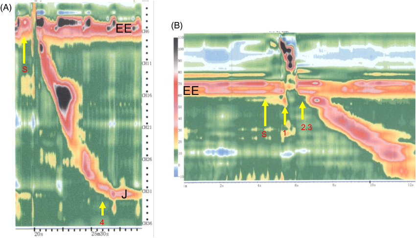 Pressure topography plots of the esophagus during a swallow by a healthy person.