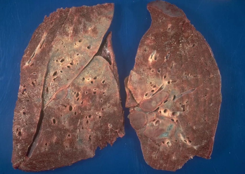 Sarcoidosis of lungs, symptoms of sarcoidosis in lungs, treatment for sarcoidosis of lungs, sarcoidosis of the lungs prognosis, stages of sarcoidosis of the lungs, sarcoidosis lungs life expectancy, sarcoidosis of the lungs diagnosis