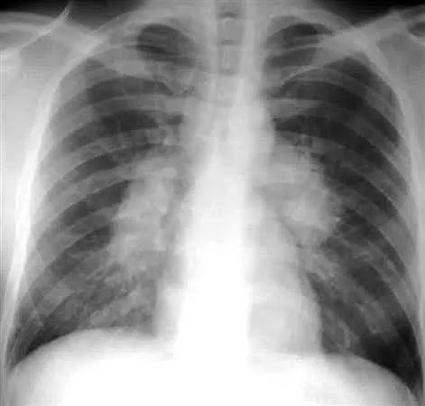 Sarcoidosis of lungs, symptoms of sarcoidosis in lungs, treatment for sarcoidosis of lungs, sarcoidosis of the lungs prognosis, stages of sarcoidosis of the lungs, sarcoidosis lungs life expectancy