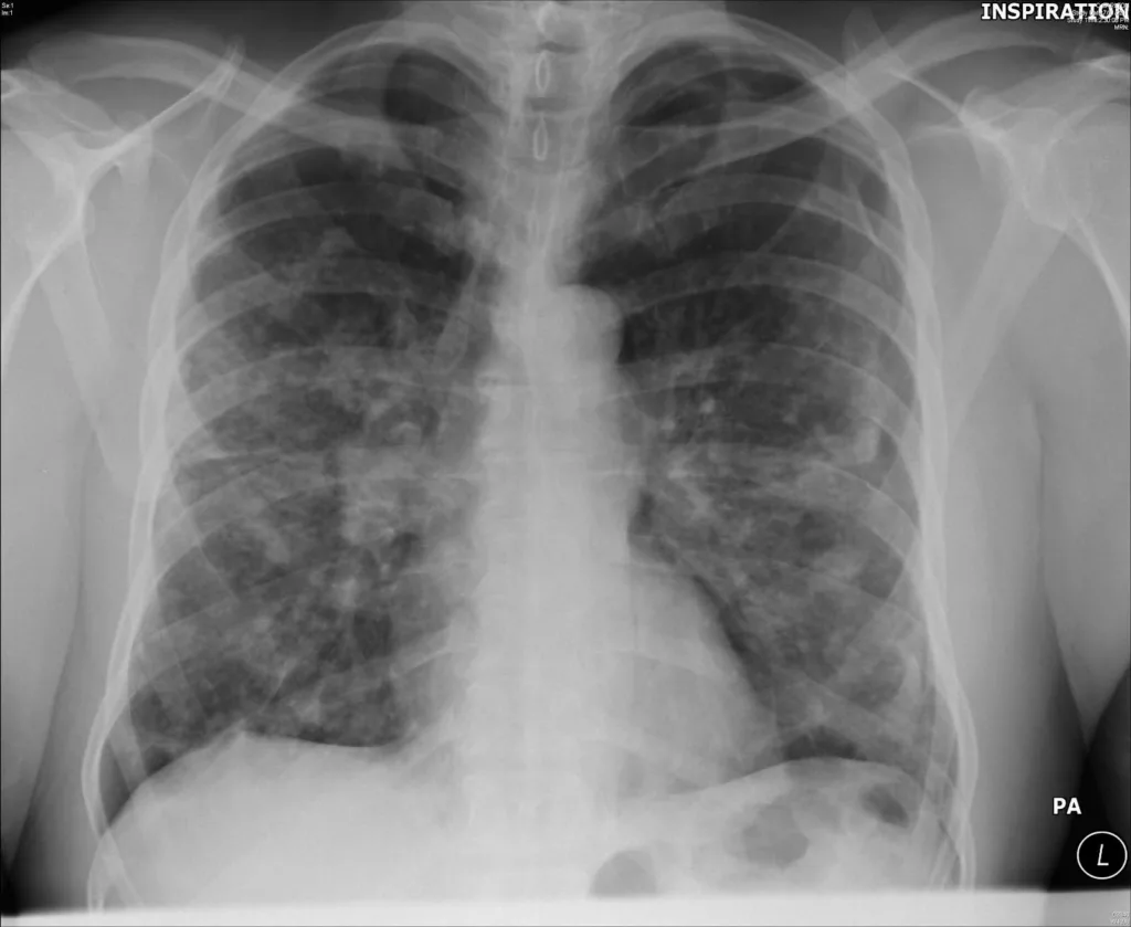 Stage 3 of Lung Sarcoidosis 