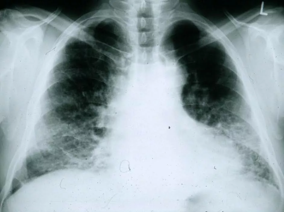 Stage 4 of Lung Sarcoidosis