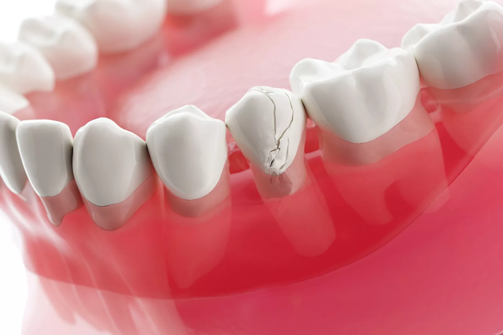 3D image of cracked tooth