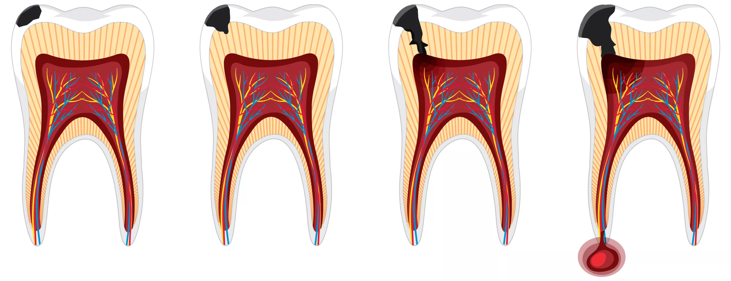 Tooth decay